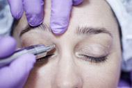 Diamant Microdermabrasion